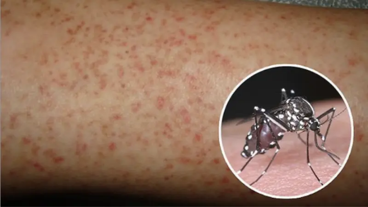 Hà Nội ghi nhận gần 400 ca sốt xuất huyết trong tuần